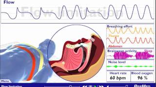 Understanding Sleep Disordered Breathing [upl. by Krissy]