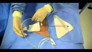 Insertion of Transvenous Pacemaker [upl. by Elnukeda494]