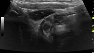 How to do abdominal ultrasound examination [upl. by Trawets]