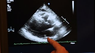 Echocardiogram Demonstration [upl. by Oster]