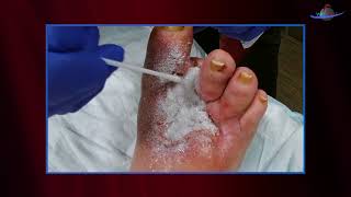 WCW Applying Altrazeal to a Post Surgical Diabetic Foot Ulcer [upl. by Kerry432]