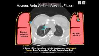 Chest Radiology The Azygous Fissure a normal variant [upl. by Middlesworth]