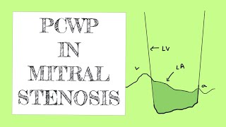 PCWP in Mitral Stenosis [upl. by Falkner]